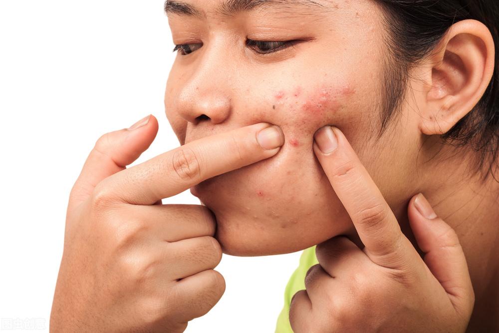 全面解析，痤瘡怎么治才能好？，全面解析，痤瘡治療的有效方法與策略