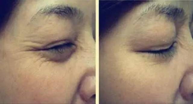 肉毒素除皺的副作用深度解析，肉毒素除皺副作用深度解析