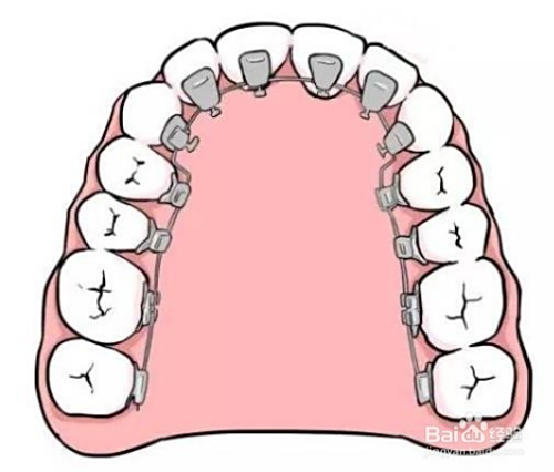 牙套價格詳解，裝一個牙套需要多少錢？，牙套價格全解析，裝牙套需要多少錢？