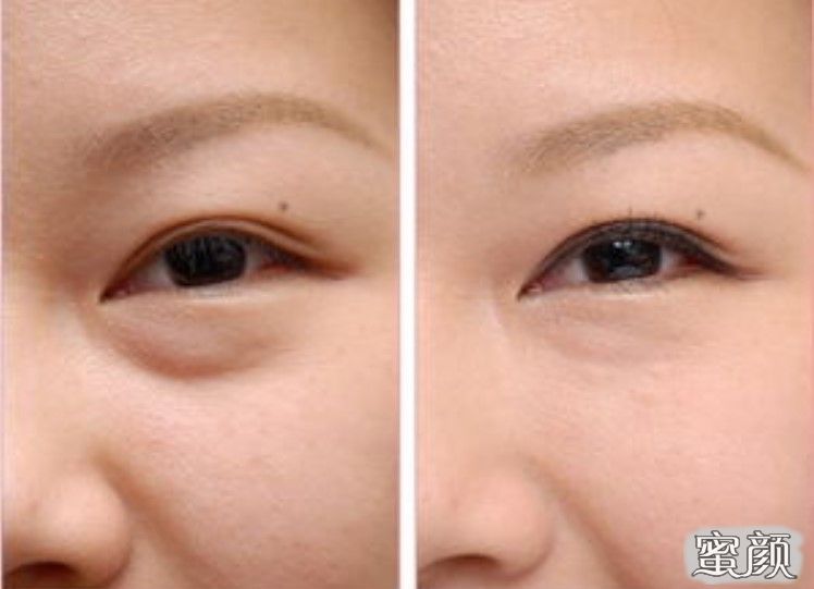 如何消除眼袋，簡單實用的方法，消除眼袋的實用方法與技巧