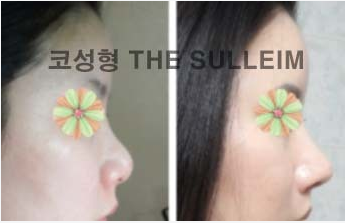 如何縮小鼻翼不手術(shù)，實用方法與建議，不手術(shù)縮小鼻翼的實用方法與建議