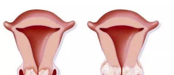 女性HPV初期感染的圖片及其相關(guān)知識(shí)科普，女性HPV初期感染圖片與知識(shí)科普，了解、預(yù)防與治療